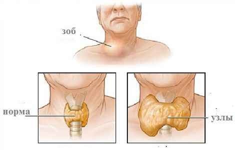 Симптомы и причины узлового зоба щитовидной железы